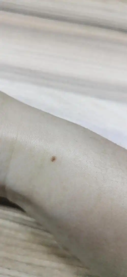 手腕上莫名其妙长出一颗痣