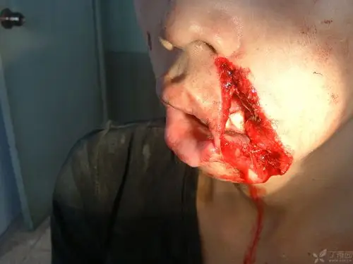 【讨论】面部电锯切割伤 [病例帖]