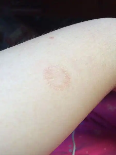 体藓,擦药一段时间之后皮肤变成了这样,类似烧伤一