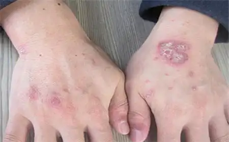 山东济南银屑病为你讲解手部有症状如何护理_沈阳中北牛皮癣医院