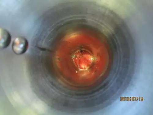 混合痔手术3年钛钉怎么没有未脱