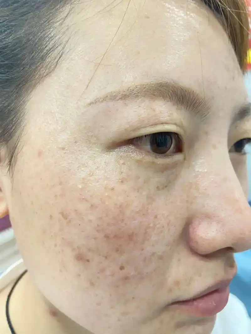 黄褐斑雀斑七十天效果皮肤好了一切都好了