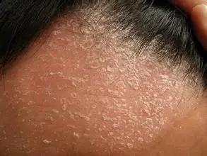 我们对银屑病都有1定的了解,头部出现银屑病以后,很多患者的头皮就会