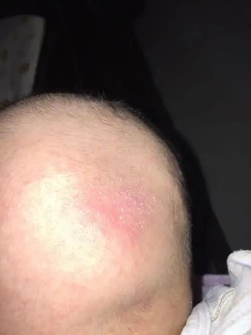 宝宝后脑勺头发剃光了,出了好多红疙瘩,朋友们知道怎么回事嘛?