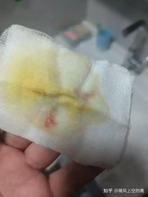 记一记自己痔疮手术后的情况