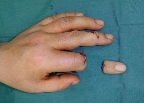 手指离断残修后8小时仁慈医院医生重新再植成功