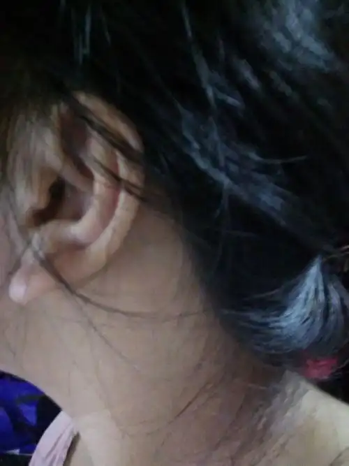 女生耳垂外翘而且又厚丑死了怎么办啊