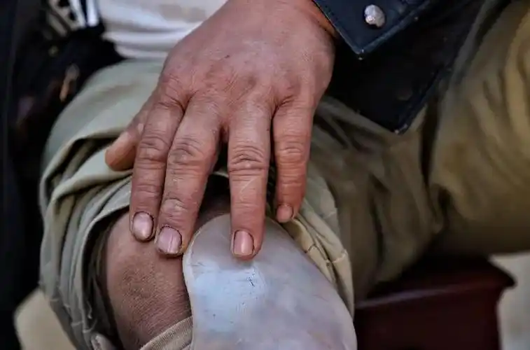 他只有左手健全,右手被高位截肢,2013年,右腿截去脚掌;2015年,左脚掌