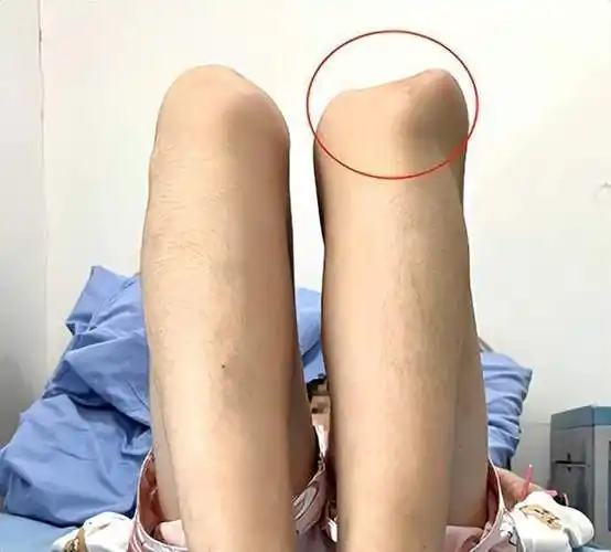 9岁女孩膝盖骨老"脱轨"?背后原因竟是髌骨脱位在作崇_腾讯新闻