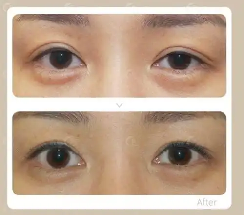提肌改善大小眼前后对比照