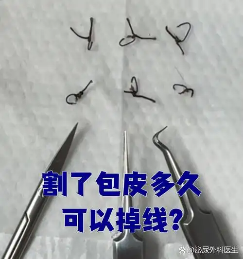 包皮环切手术后,缝线一般需要2周左右才能自然脱落