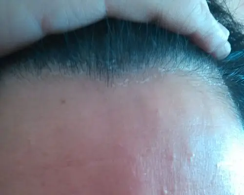 关于头皮干燥脱皮的问题,请高手支招,采纳后在追加20分!