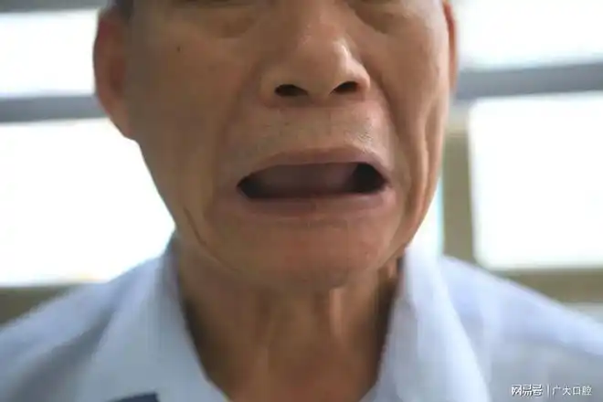 下半口全口缺牙饮食上,因为没有锋利的牙齿可以切割,研磨食物,基本和