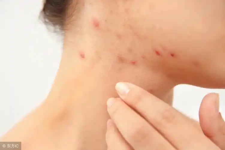 毛囊炎症状和图片(怎样快速正确区分毛囊炎和痤疮)