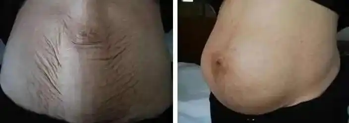 生完孩子后肚皮松松垮垮,减肥,健身不见效果,到底是什么原因?