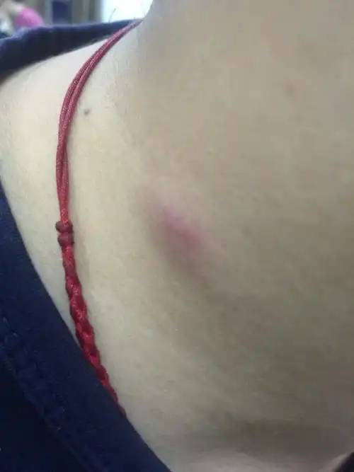 这是毛囊炎吗?里面是硬的!刚开始一模就疼,现在不疼不痒,但是硬块