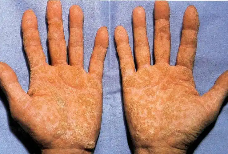 点状掌跖角皮症-临床皮肤病学-医学