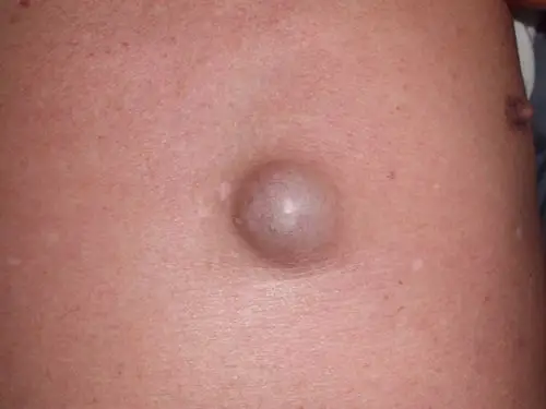皮肤囊肿图片 (30)_有来医生