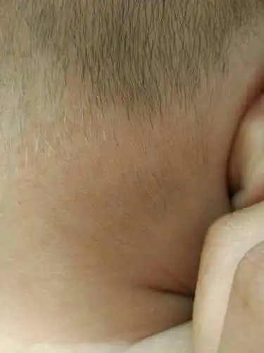 七个月的宝宝后脑勺长了一片白头发怎么回事.