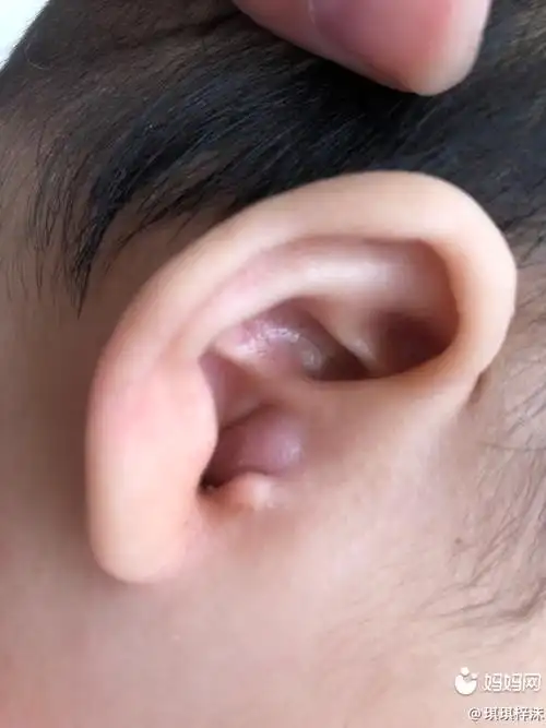五个月的宝宝耳朵里长疖子怎么办啊