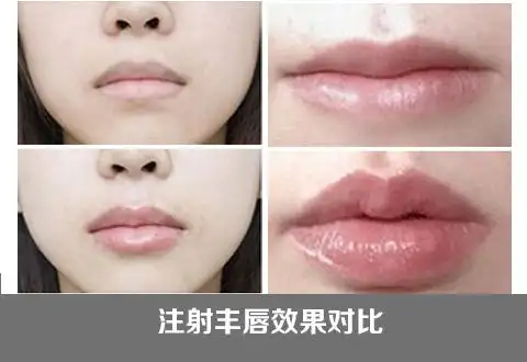 口唇部整形