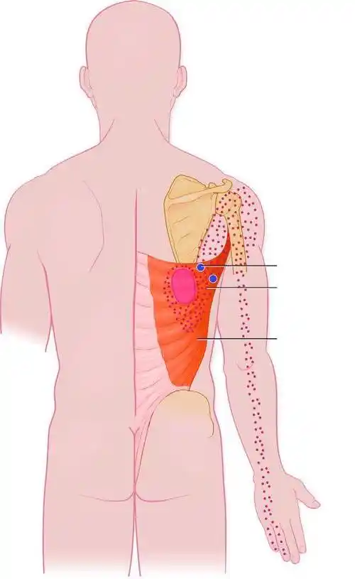 肩胛骨下角疼痛怎么治?_疼痛 - 好大夫在线