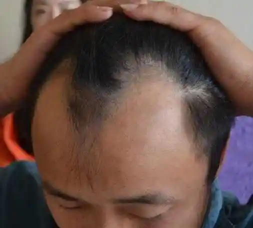 线后退图为黄先生额角 发际线生发一年后的样子两边的秃额角不见了