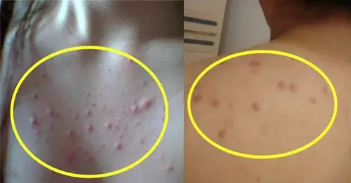 ads                                        马拉色菌毛囊炎是一种