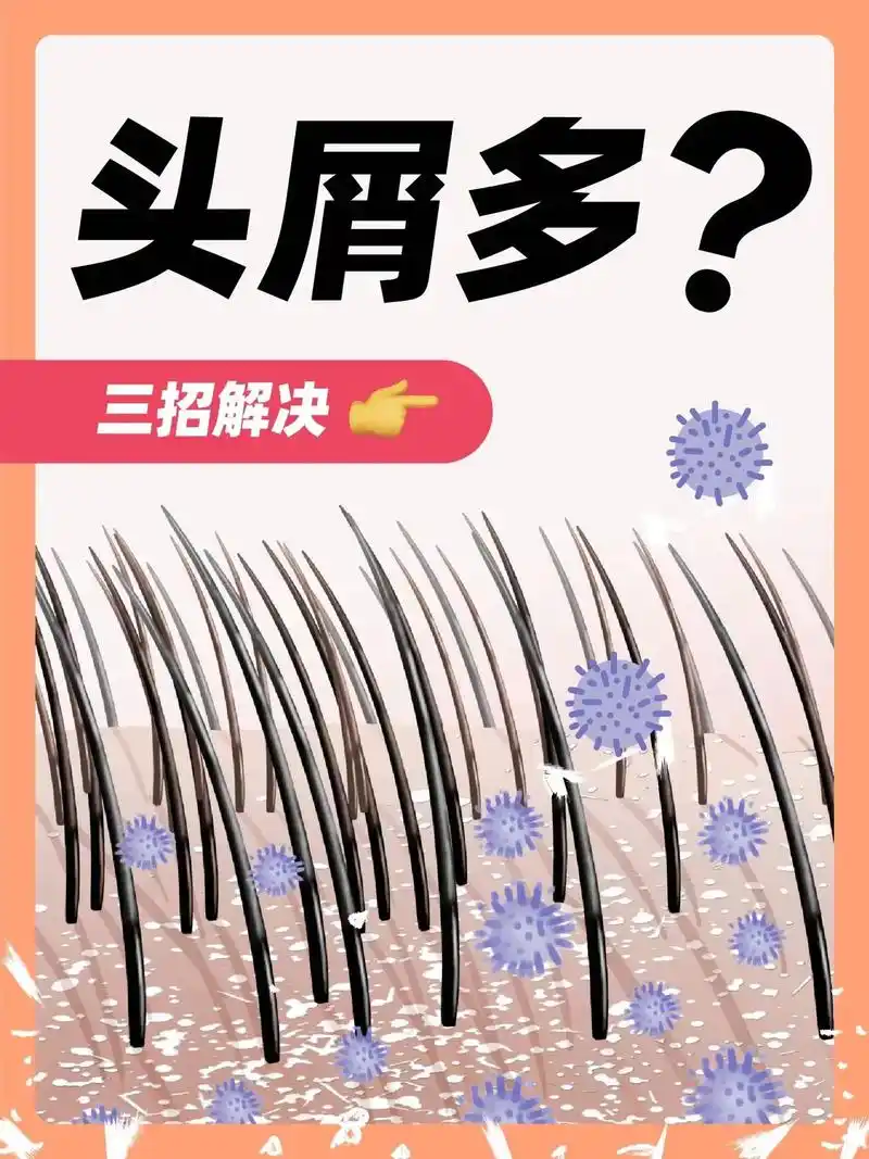 头油头痒头屑多,到底该怎么办?三招解决!你知道你的头皮屑从哪 - 抖音