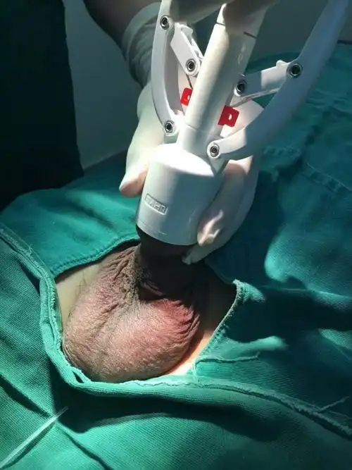 包皮环切吻合器