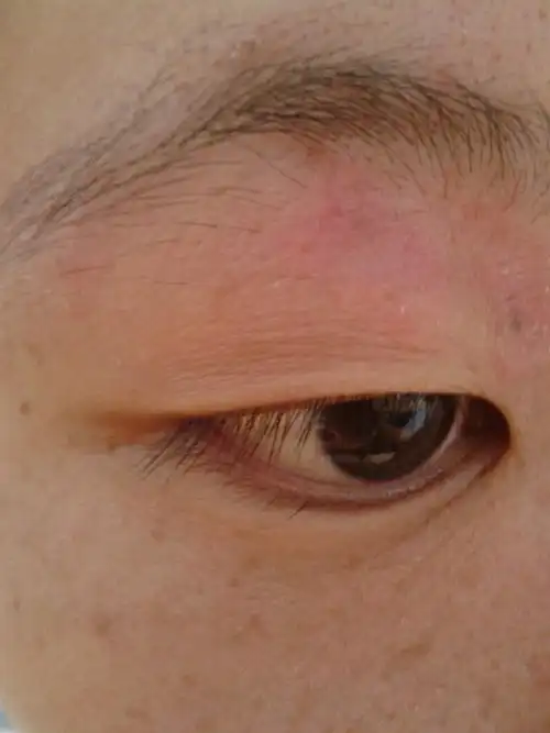 43王建磊医师 回答: 病情分析: 你好,这种情况应该是皮炎的症状