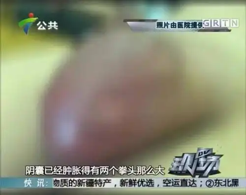 短短三天,他的阴囊肿得有两个拳头那么大,而且腹痛丝毫没有减弱的迹象