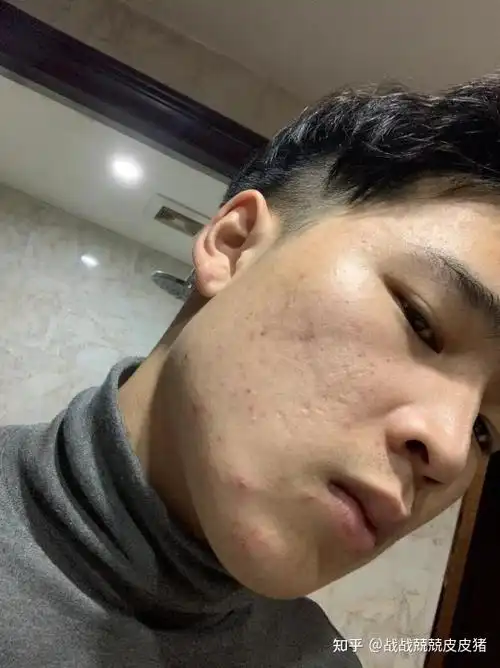 改善皮肤粗糙,细腻毛孔