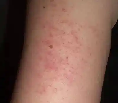 青春痘,干藓……数数那些因肥胖而起的皮肤病