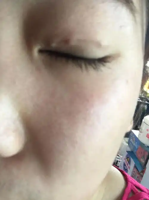埋线双眼皮第十三天,线结反应怎么办?没时间去医院,热敷管用吗?