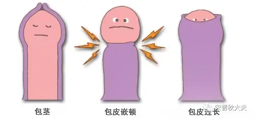 【热点】孩子的包皮到底要不要切?_手术