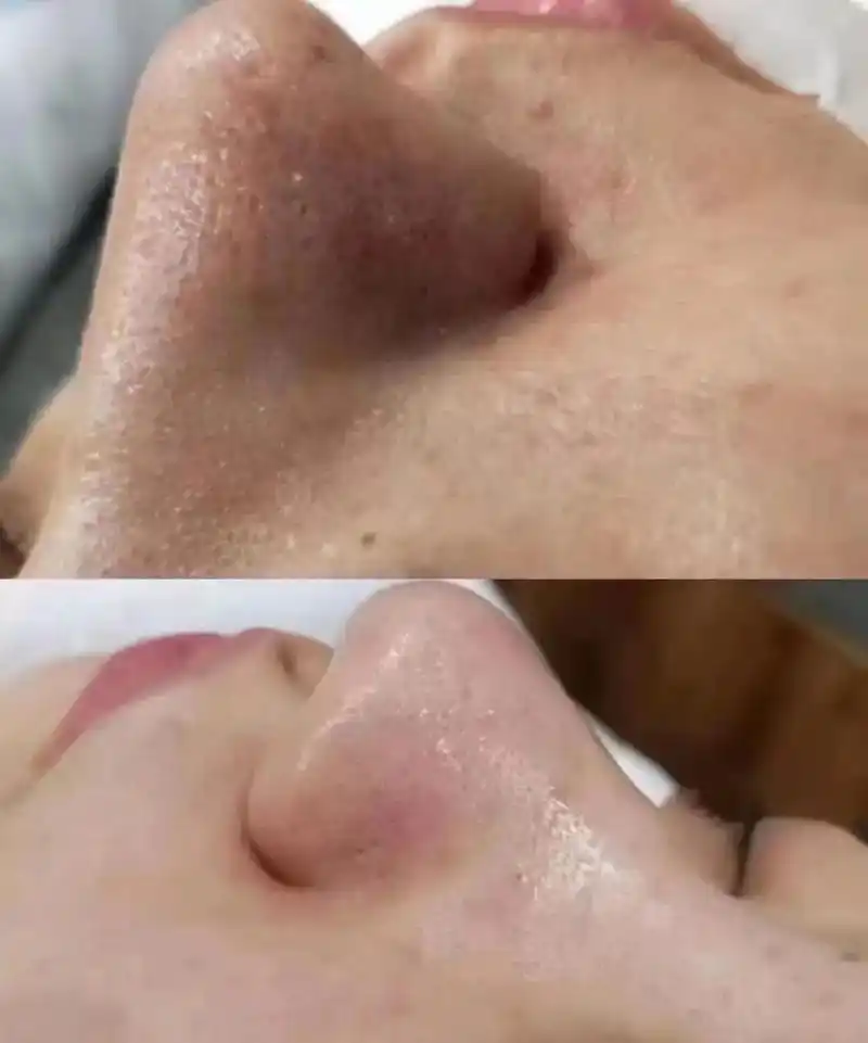 皮肤的万"病"之源于毛孔堵塞[恐惧]如:毛孔粗大,开放性/闭 - 抖音