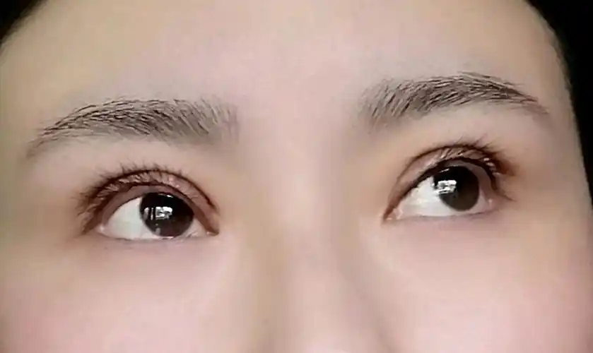 请问全切双眼皮后两个月了上眼睑外翻平视前方能看到睫毛根部下的白色