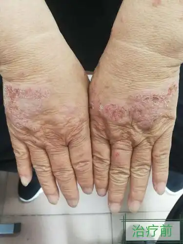 多形性日光疹1例