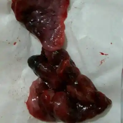 姨妈一样,刚刚流出来了图中的东西,大夥帮忙看看是不是已经自然流产了