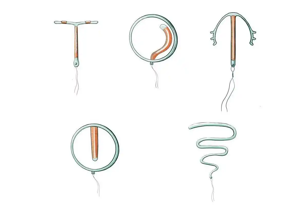 节育环是用来辅助避孕的工具,可以起到阻止受精卵着床的作用,从而达到