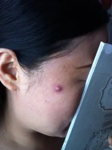 颜面的小痘痘和小疖肿尽量不要去人为的挤破挑开,会导致细菌炎症扩散