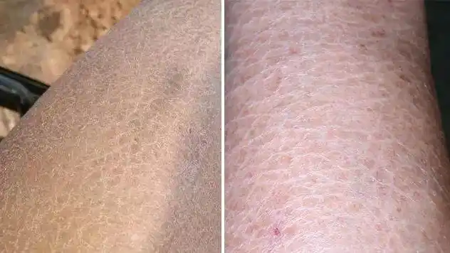 皮肤干燥到脱衣就飘雪花,穿黑色裤子干皮到处都是,被旁人看到提醒你抹