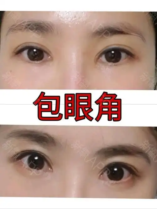 去韩国包眼角已经4个月了 一点疤痕都没有 一个月的_圈子-新氧美容