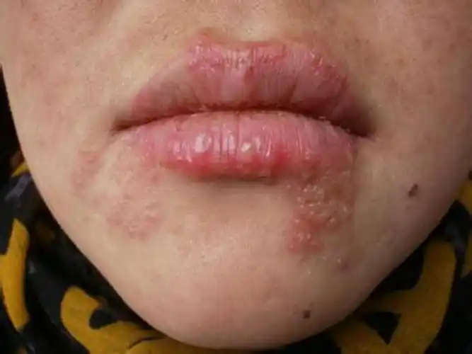 抚州疱疹医院_抚州治疗疱疹哪家医院好_抚州治疗疱疹权威的医院/排行