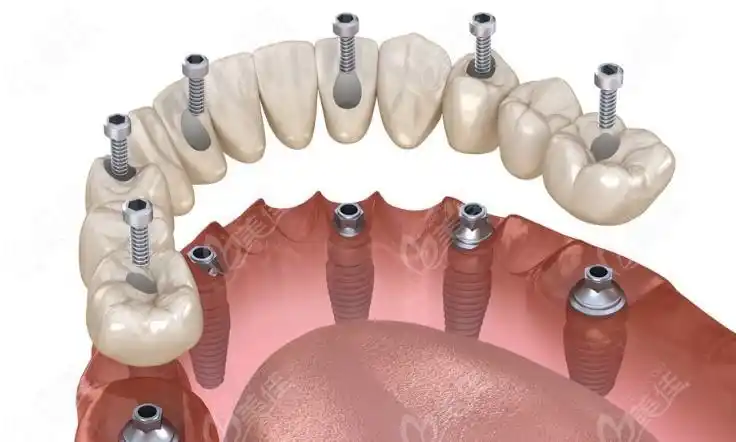 苏州全口种植牙