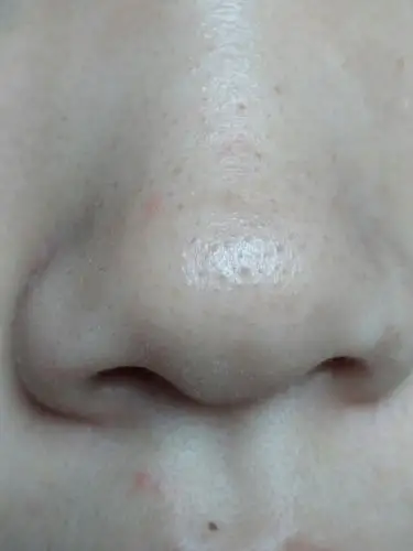 谁能看看我鼻子上的黑头怎么去除,黑黑的一片自己每次看到都心情非常