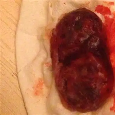 人流后排卵期出血是什么症状