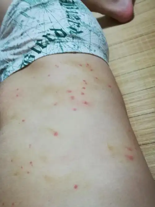 皮肤及性传播疾病讨论版 - 爱爱医医学论坛