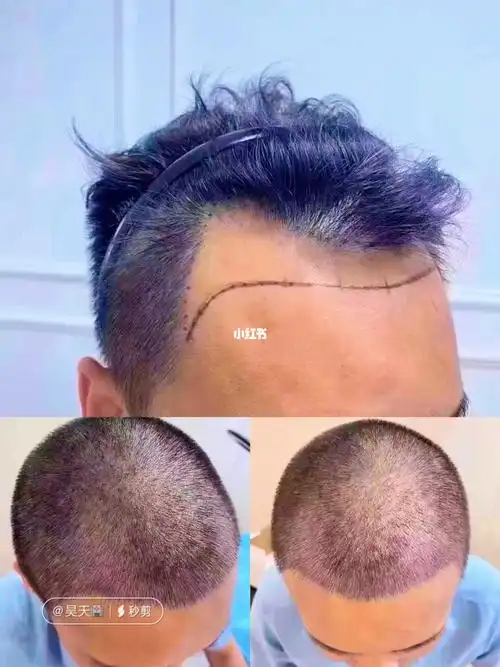 男士额角77发际线植发